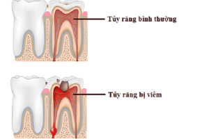 Viêm tủy răng: Khi nào cần điều trị? | Vinmec
