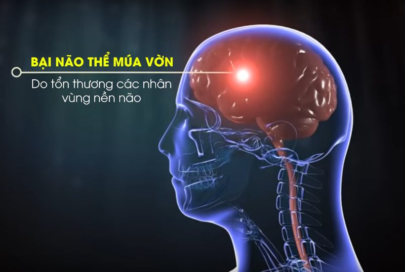 Bại não: Nguyên nhân, triệu chứng và cách điều trị hiệu quả