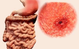 Bệnh Crohn là gì? Nguyên nhân, triệu chứng và cách điều trị hiệu quả