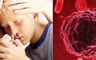 Bệnh máu trắng: Nguyên nhân, triệu chứng và cách điều trị hiệu quả