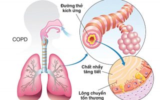 Bệnh phổi tắc nghẽn mạn tính: Nguyên nhân, triệu chứng và cách điều trị