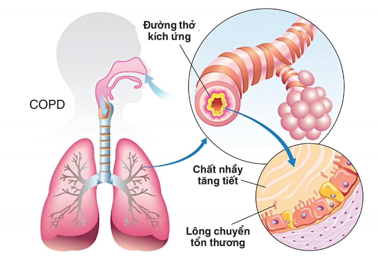 Bệnh phổi tắc nghẽn mạn tính: Nguyên nhân, triệu chứng và cách điều trị