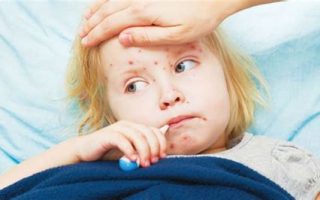 Bệnh sởi ở trẻ em: Nguyên nhân, triệu chứng, biến chứng và cách phòng ngừa