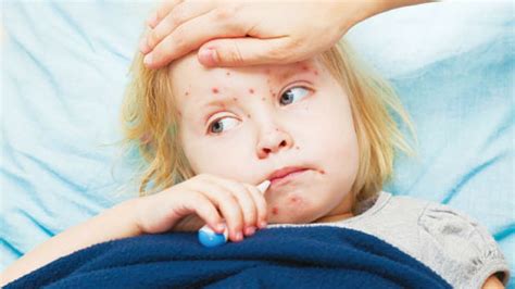 Bệnh sởi ở trẻ em: Nguyên nhân, triệu chứng, biến chứng và cách phòng ngừa