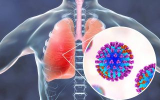 Bệnh viêm phổi: Nguyên nhân, triệu chứng, phòng ngừa và điều trị hiệu quả