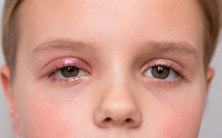 Bị lẹo mắt có nguy hiểm không? Cách phòng và điều trị hiệu quả