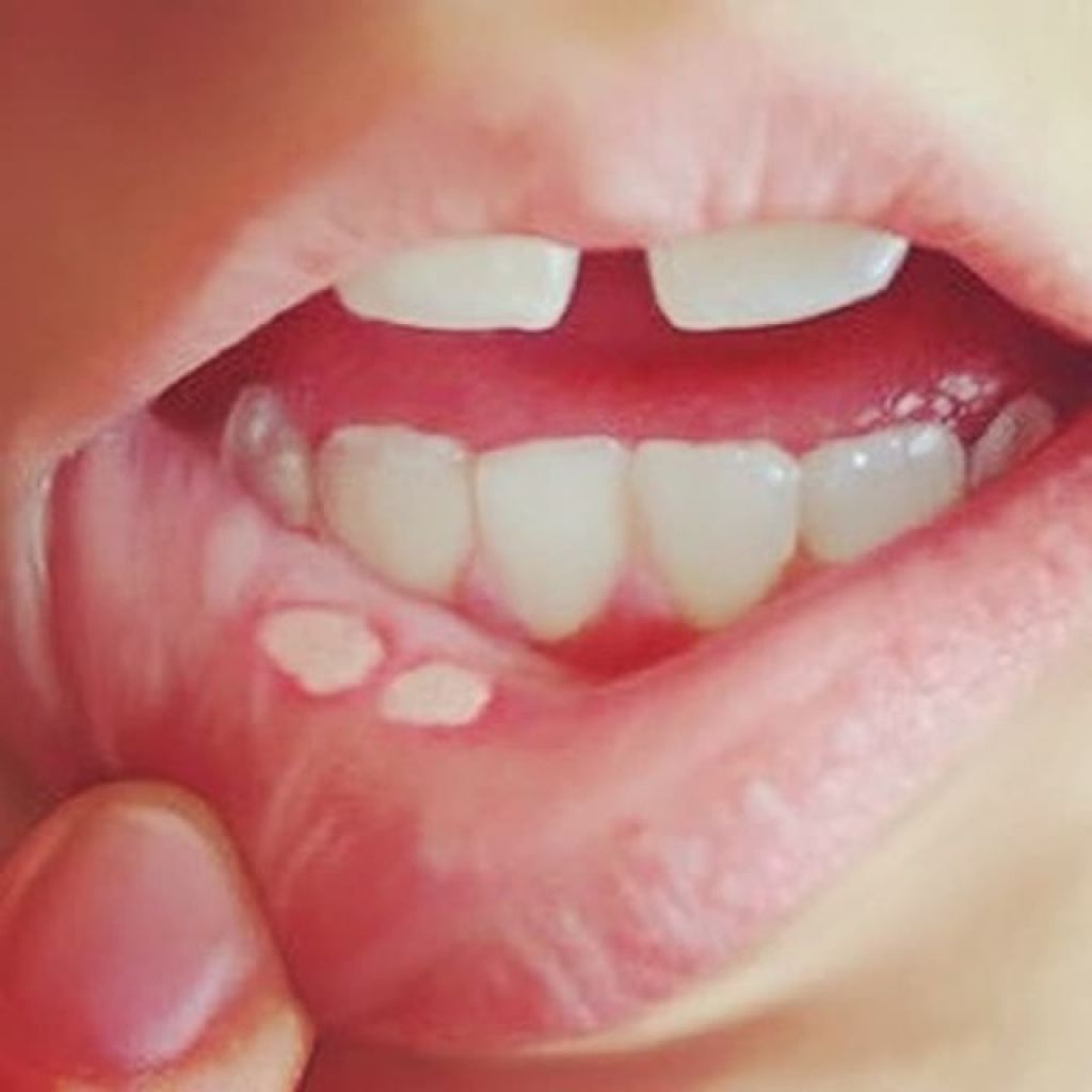 Bị nhiệt miệng nặng và nhiệt lưỡi: Nguyên nhân, cách điều trị và những thực phẩm nên ăn