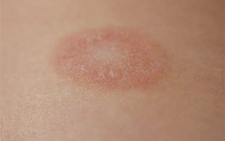 Bị nổi vòng tròn đỏ trên da: Nguyên nhân, triệu chứng và cách điều trị