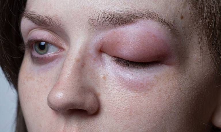 Bị sưng mắt là bệnh gì? Nguyên nhân, triệu chứng và cách điều trị hiệu quả