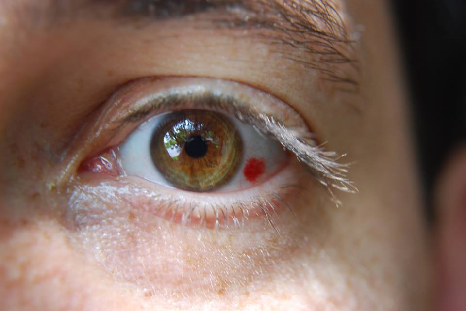 Cách làm tan vết tụ máu trong mắt: Bí quyết từ các chuyên gia y tế
