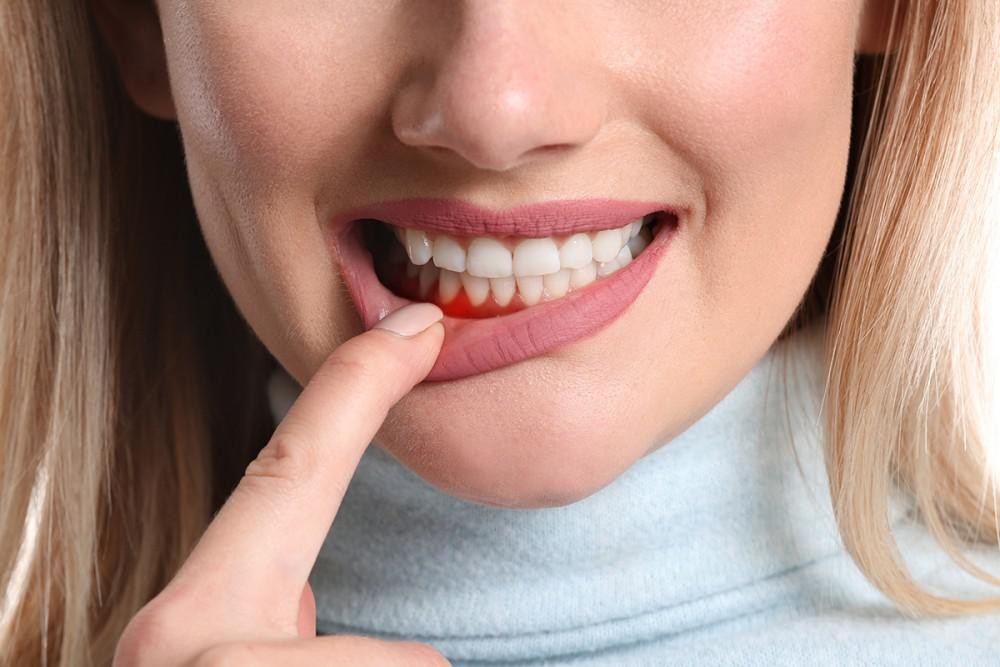 Chảy máu chân răng: Nguyên nhân, cách xử lý và phòng ngừa
