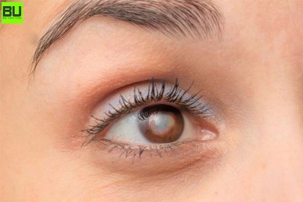 Cườm mắt: Nguyên nhân, triệu chứng và cách điều trị hiệu quả