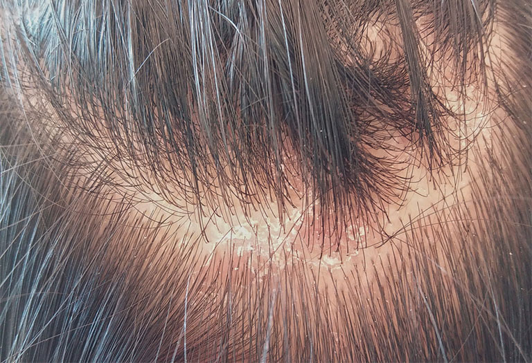 Da đầu bị nấm: Nguyên nhân, triệu chứng và cách điều trị hiệu quả