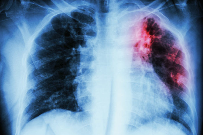 Dấu hiệu lao phổi: Nhận biết sớm để điều trị kịp thời