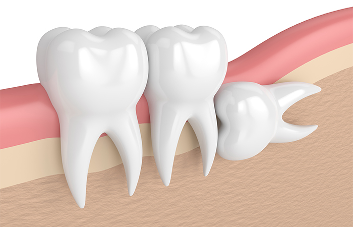 Dấu hiệu mọc răng khôn: Bạn có biết răng khôn có thể gây ung thư miệng?