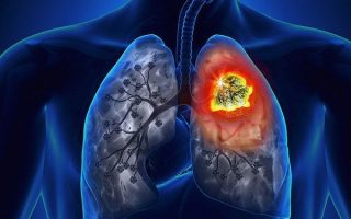 Dấu hiệu viêm phổi: Làm thế nào để nhận biết sớm và phòng ngừa bệnh?