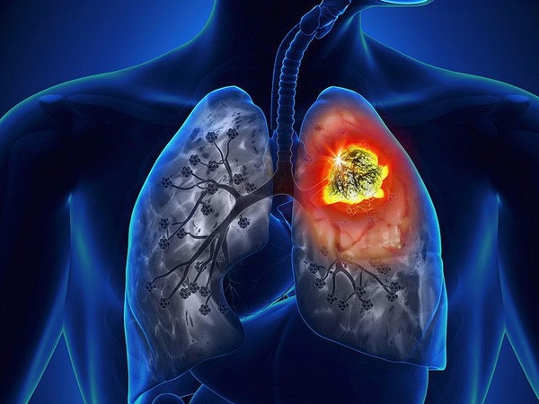Dấu hiệu viêm phổi: Làm thế nào để nhận biết sớm và phòng ngừa bệnh?