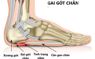 Gai gót chân: Nguyên nhân, triệu chứng và cách điều trị hiệu quả