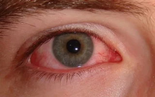 grass dust and tree pollen may cause allergic pink eye br image credit p33tr 2007 1024x575 1
