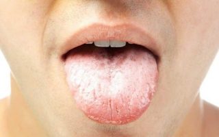 Lưỡi trắng là bệnh gì? Nguyên nhân, triệu chứng và cách điều trị hiệu quả