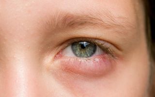 Mắt sưng húp: Nguyên nhân, triệu chứng và cách chữa trị hiệu quả