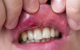 mouth blister shown by stretching lips 1536x1026 1