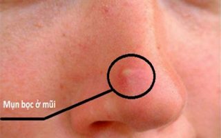 Mụn ở mũi: Làm sao để loại bỏ hoàn toàn và ngăn ngừa tái phát?