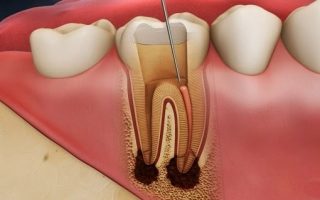 Tất tần tật viêm tủy răng: Nguyên nhân, triệu chứng, điều trị và cách