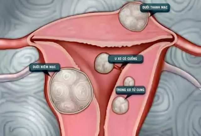 Nhân xơ tử cung là gì? Nguyên nhân, triệu chứng và cách điều trị hiệu quả