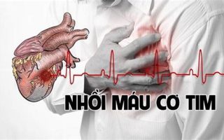 Nhồi máu cơ tim: Nguyên nhân, triệu chứng, phòng ngừa và điều trị hiệu quả