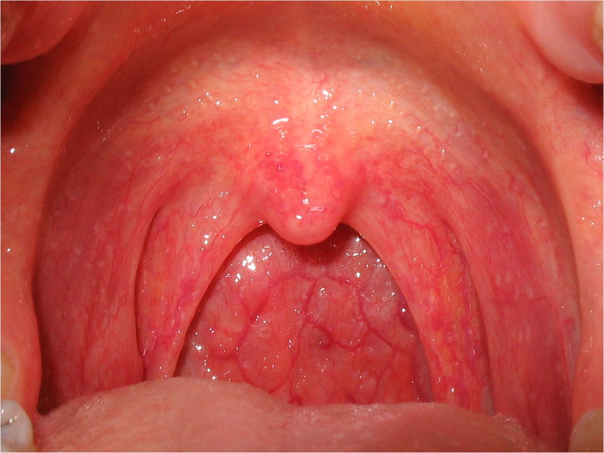Nuốt nước bọt đau họng: Nguyên nhân, triệu chứng và cách chữa trị hiệu quả