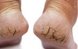 Nứt gót chân: Nguyên nhân, triệu chứng và cách điều trị hiệu quả
