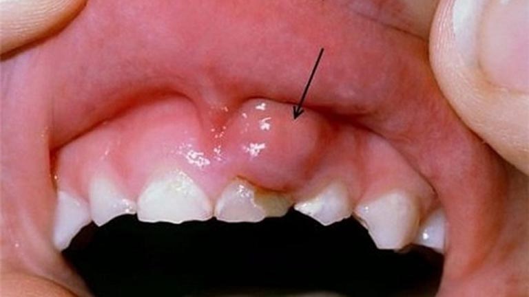 Sưng nướu răng: Nguy hiểm hơn bạn nghĩ! Cách phòng và điều trị hiệu quả