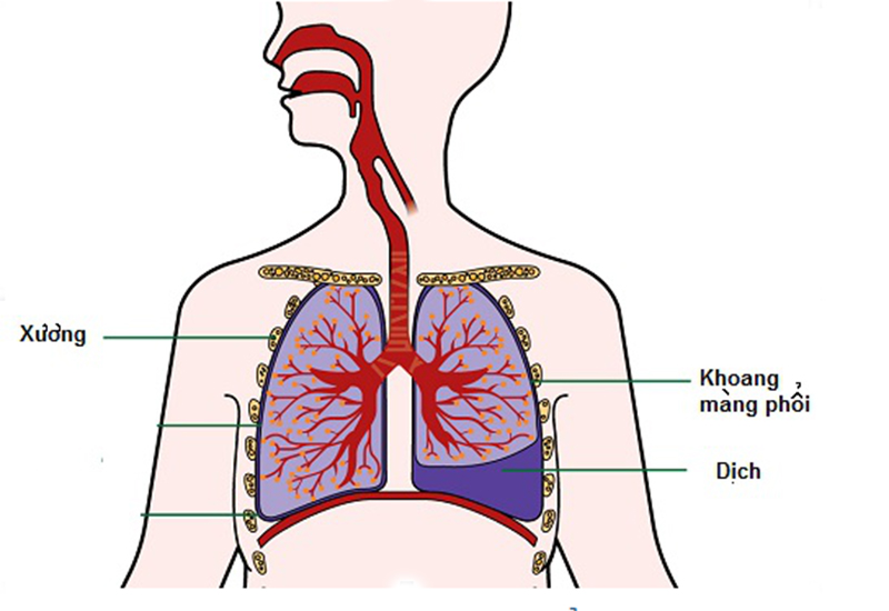 Tràn dịch màng phổi: Nguyên nhân, triệu chứng, cách phòng ngừa và điều trị hiệu quả