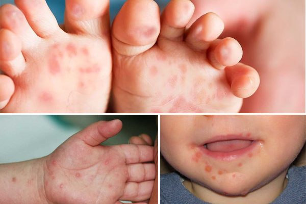 Trẻ bị chân tay miệng: Nguyên nhân, triệu chứng và cách chăm sóc hiệu quả
