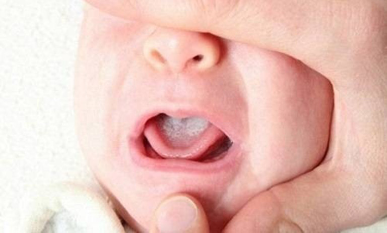 Trẻ bị nấm miệng: Nguyên nhân, triệu chứng và cách điều trị hiệu quả