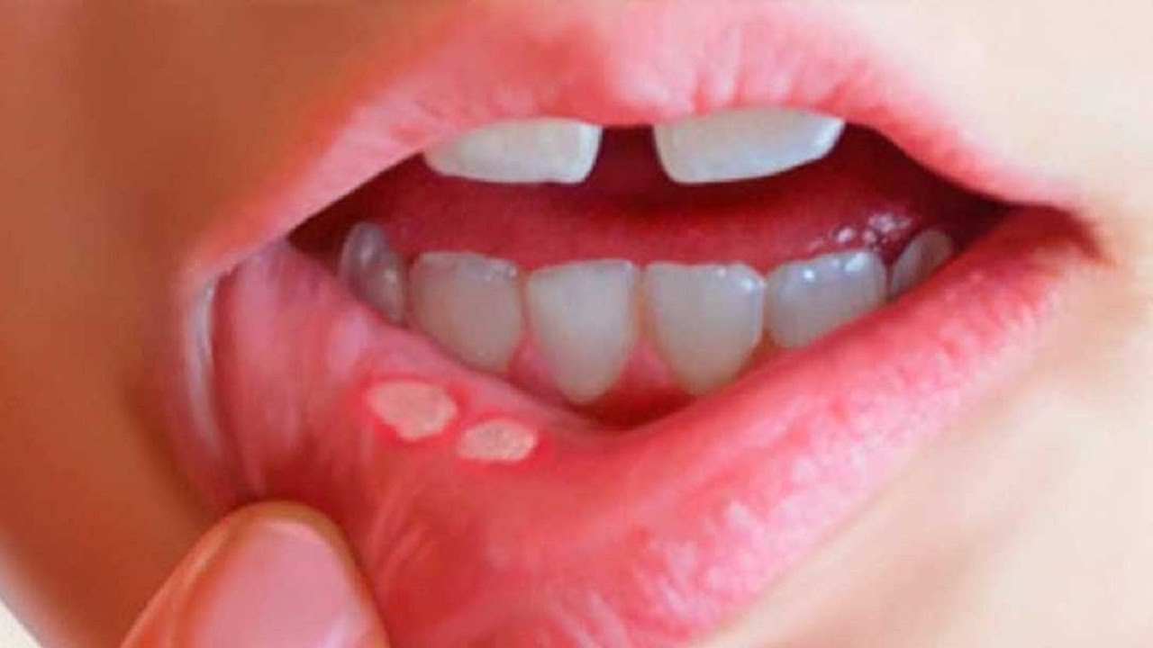 Trẻ bị nhiệt miệng: Nguyên nhân, triệu chứng và cách điều trị hiệu quả