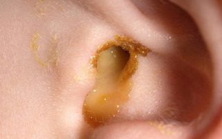 Trẻ bị viêm tai giữa: Nguyên nhân, triệu chứng và cách điều trị hiệu quả