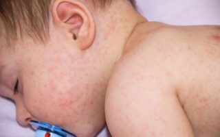 Triệu chứng sốt siêu vi ở trẻ em: Nguyên nhân, biểu hiện và cách điều trị