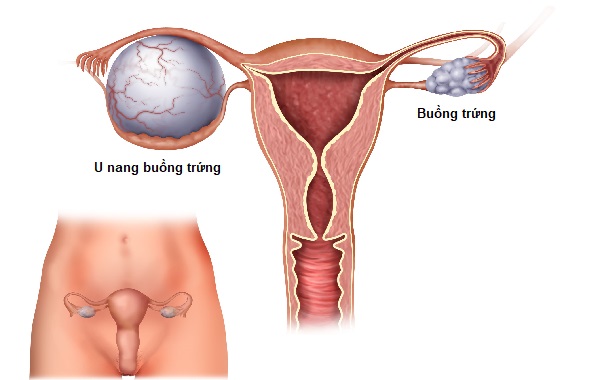U nang buồng trứng - Nguyên nhân, triệu chứng và cách điều trị hiệu quả
