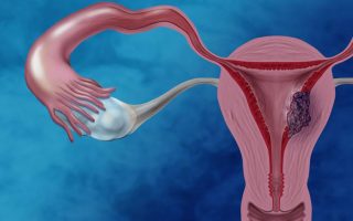 Ung thư nội mạc tử cung: Nguyên nhân, triệu chứng và cách phòng ngừa