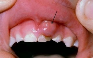 Ung thư nướu răng: Nguyên nhân, triệu chứng và cách điều trị hiệu quả