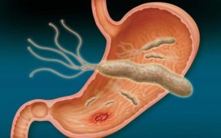 Vi khuẩn HP - Kẻ thù ngầm gây ung thư dạ dày: Nguyên nhân, triệu chứng và cách phòng tránh