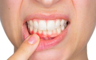 Viêm nướu và viêm nướu răng: Nguyên nhân, triệu chứng, điều trị và phòng ngừa