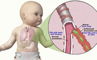 Viêm tiểu phế quản: Nguyên nhân, triệu chứng, điều trị và cách phòng ngừa cho trẻ em