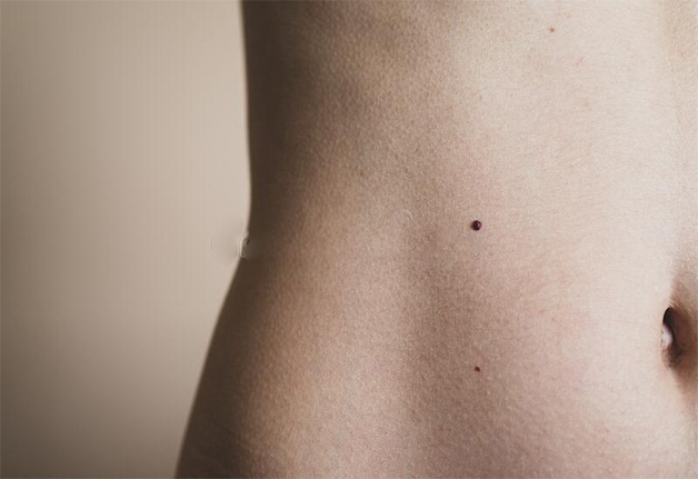 Nốt ruồi ở bụng có thể là dấu hiệu của bệnh ung thư da. Bạn nên làm gì?