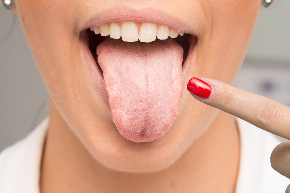 Viêm gai lưỡi: Nguyên nhân, triệu chứng và cách điều trị hiệu quả
